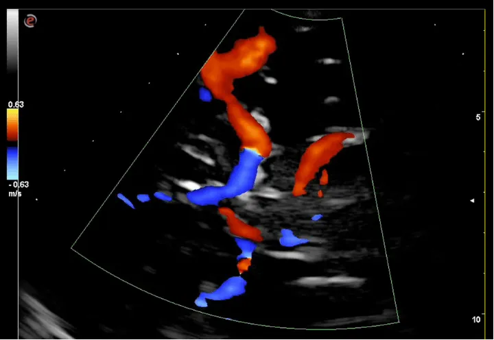 EcocolorDoppler transcranico del poligono di Willis, reperto normale con color Doppler