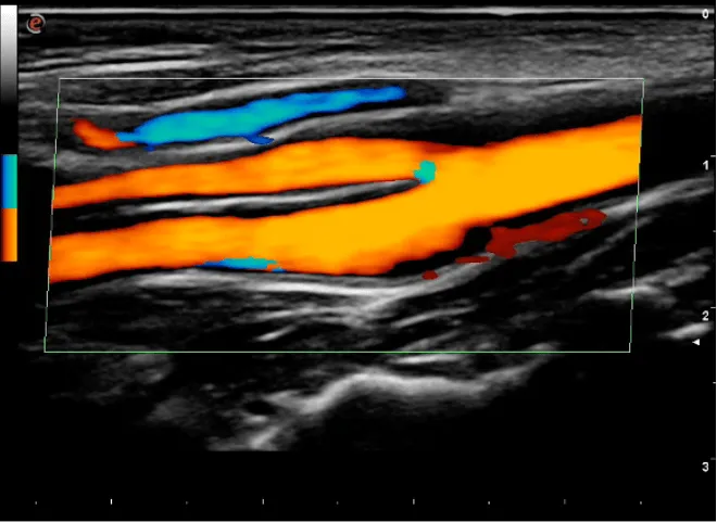 EcocolorDoppler dei tronchi sovra-aortici (TSA), sistema carotideo normale con color Doppler