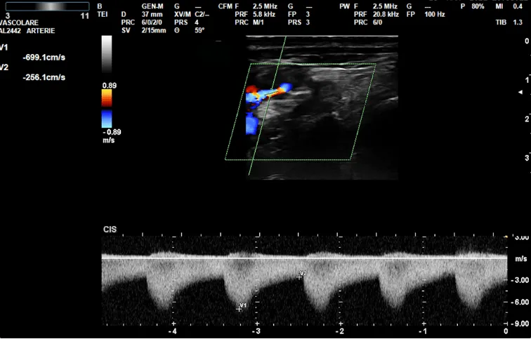 Spettro Doppler patologico con velocità aumentate, tipico di una stenosi carotidea