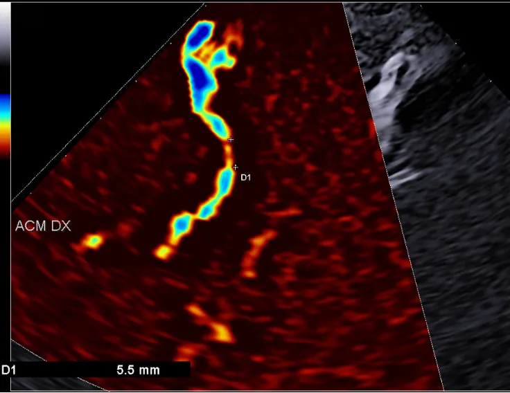 EcocolorDoppler transcranico con MicroV su una stenosi dell'arteria cerebrale media (ACM), diametro residuo 5,5 mm