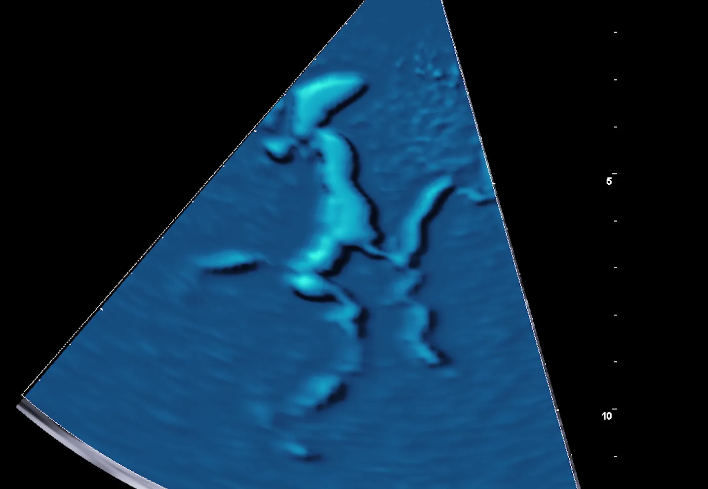 EcocolorDoppler transcranico del poligono di Willis con Power Doppler, reperto normale