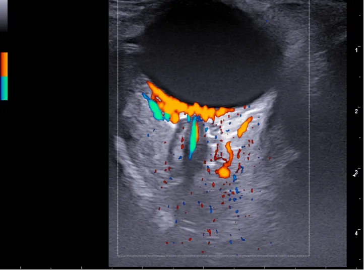 Studio orbitario: vascolarizzazione dell'occhio con color Doppler attraverso la finestra orbitaria